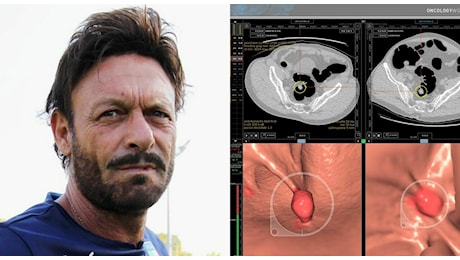 Totò Schillaci, il tumore al colon: cos'è e come si previene? Screening test, cura e mortalità. «Pazienti sempre più giovani»