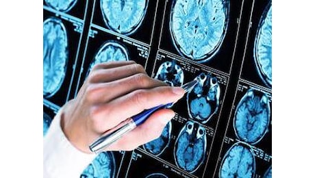 Nuova frontiera anti - Alzheimer: così si combattono le proteine tossiche