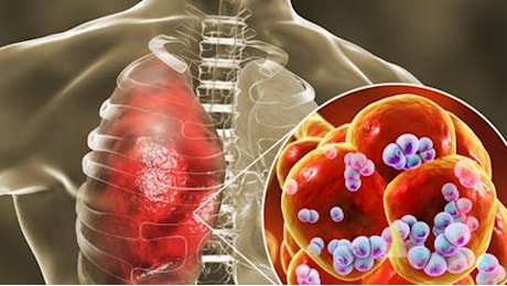 Cosa sono polmoniti e altre malattie da pneumococco, chi rischia di più, come si possono prevenire